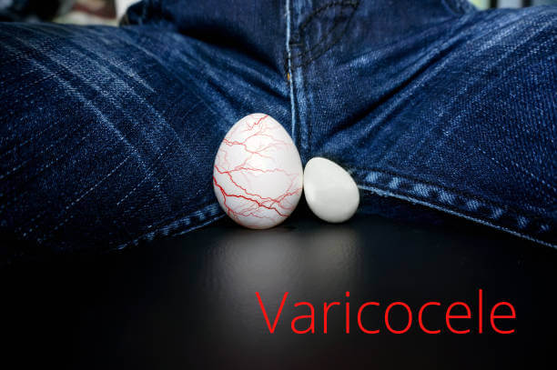 What is Varicocele And How Does It Affect Male Fertility?